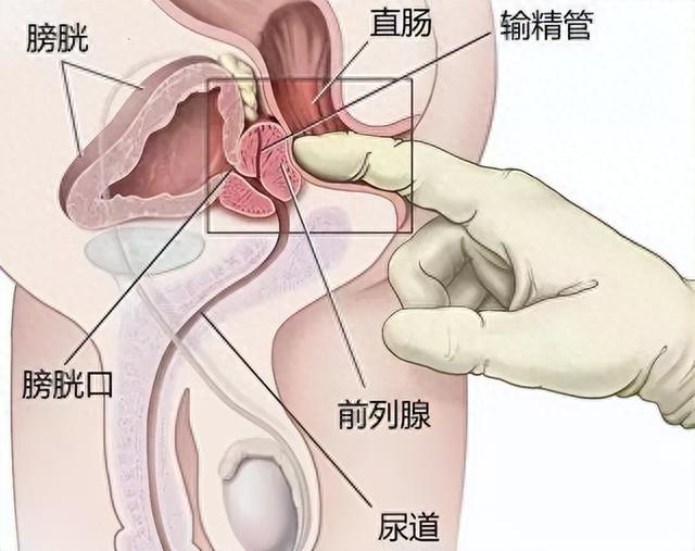 泌尿外科医生提醒，不要轻易尝试“前列腺高潮”这种不安全行为