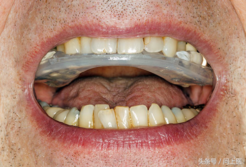 图解补牙、矫正牙齿、修补蛀牙的常见牙科用具，看看你见过几个？