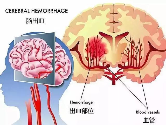 这病太可怕，有人花了130万没救回来！有这些症状要注意了！